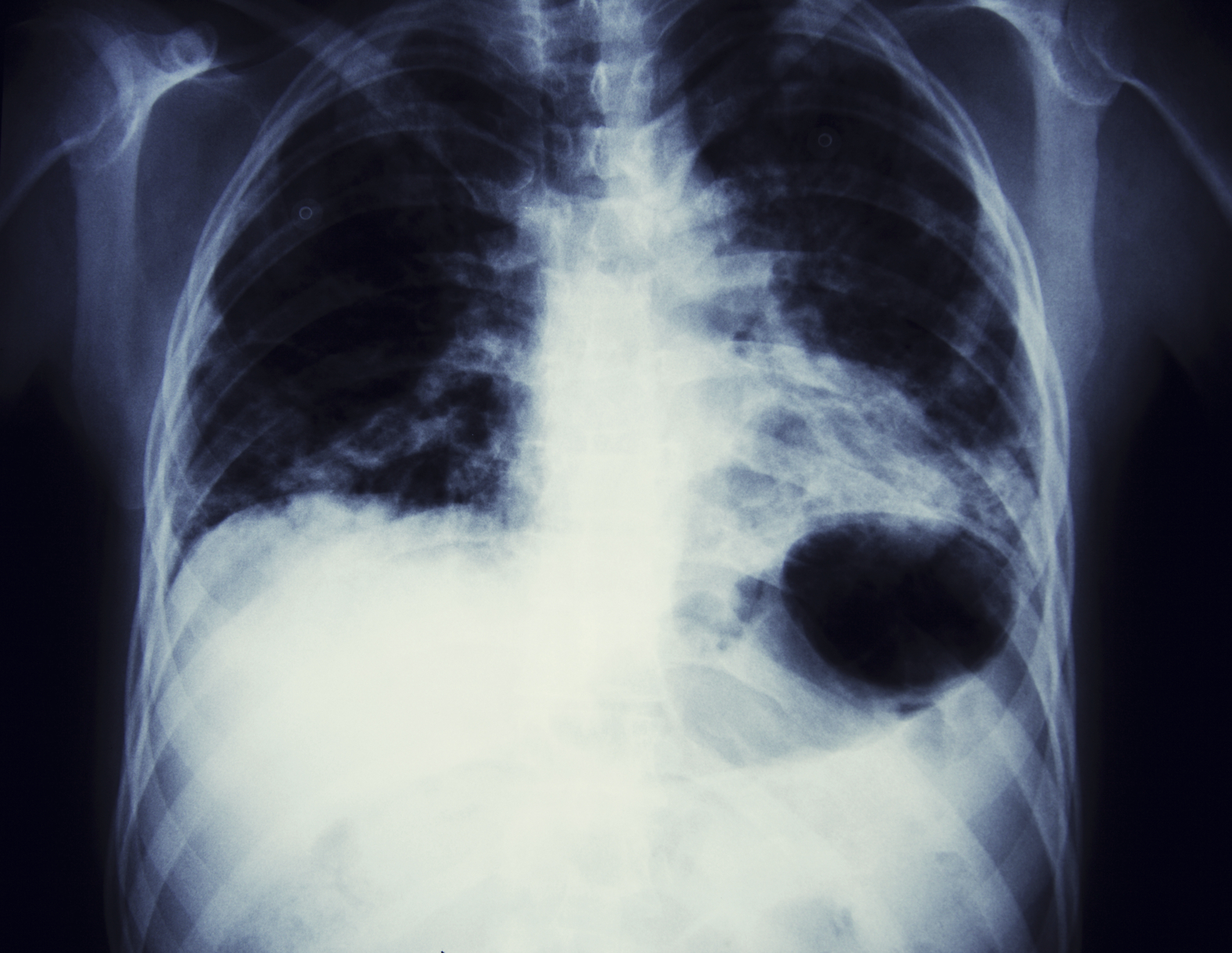 Asbestos-related lung cancer