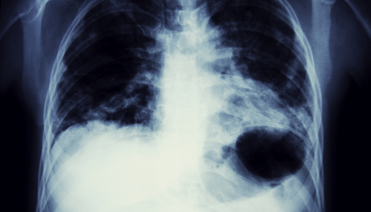 Claiming asbestos disease compensation for the death of a family member