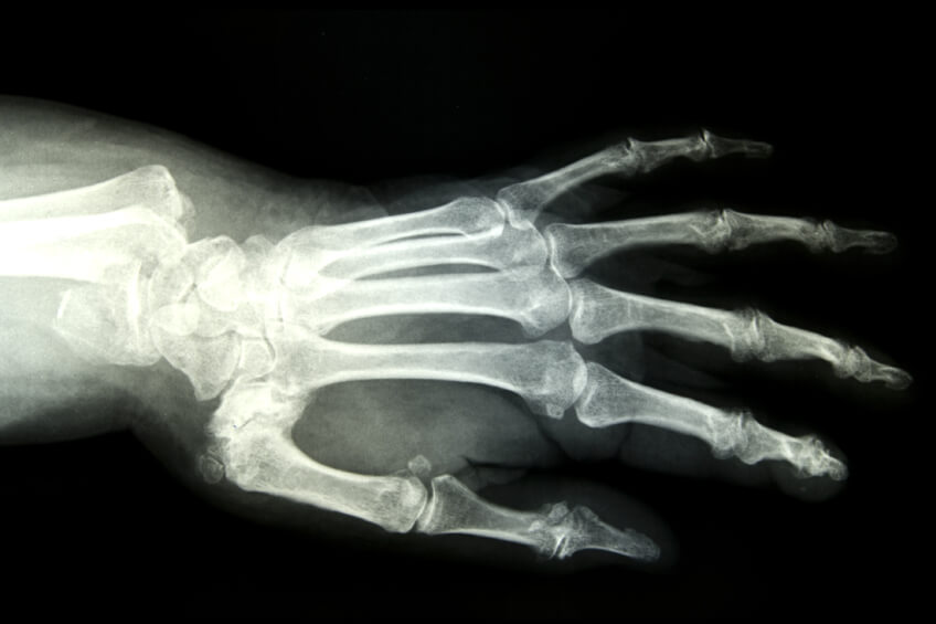 Claiming compensation for undiagnosed fractures