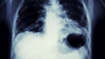 Asbestos-related lung cancer