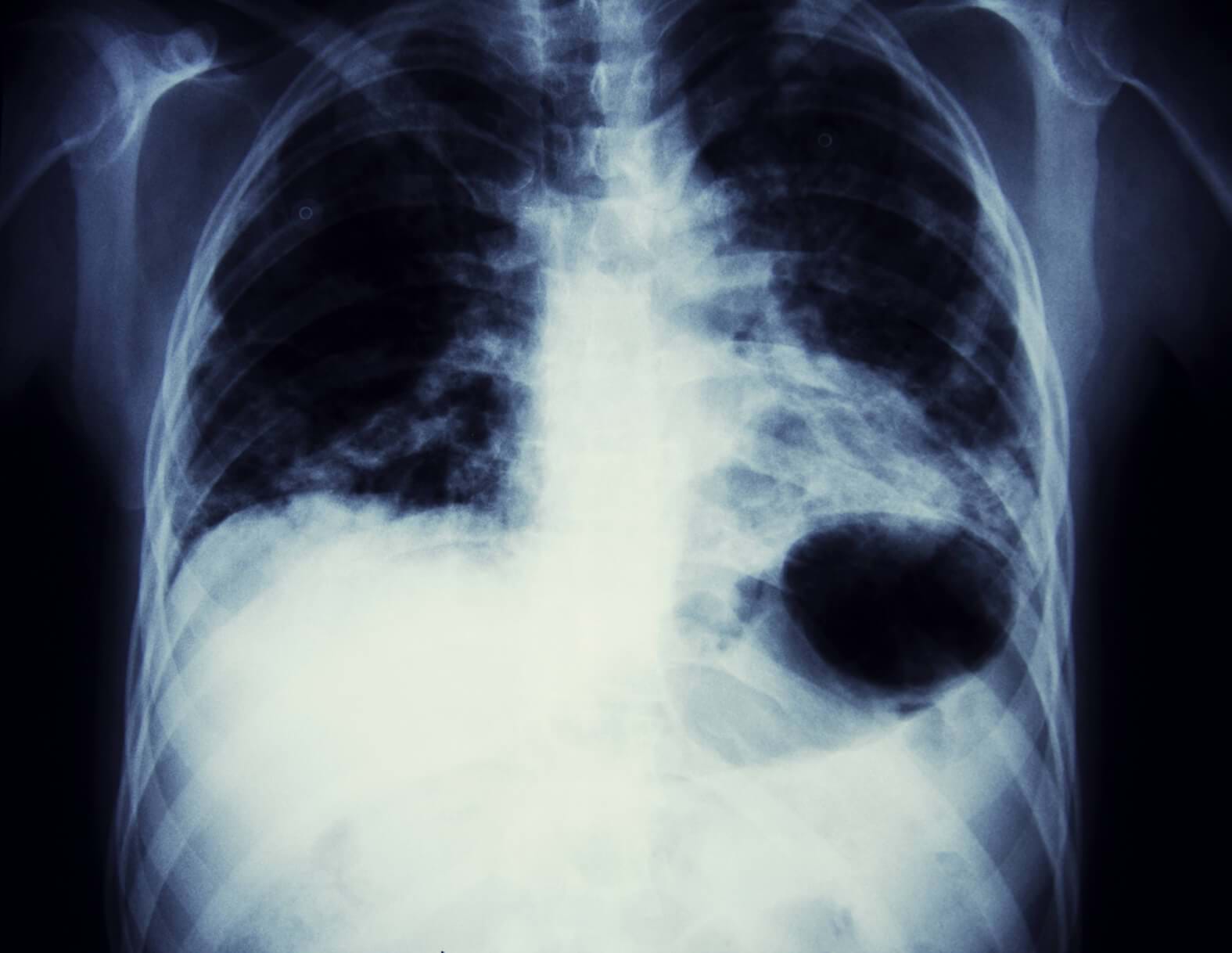 black and white x ray image of a sternum and lung