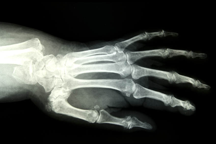 black and white x ray showing a fractured wrist