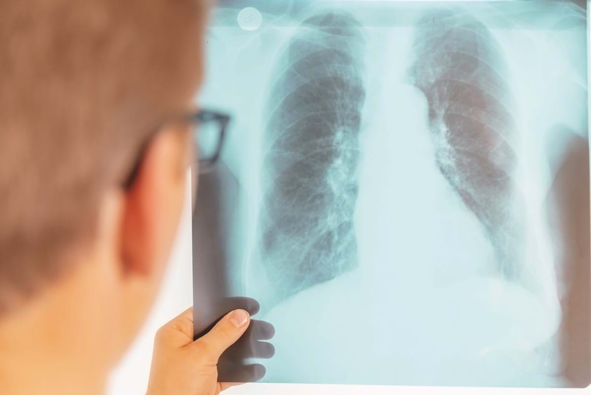 man looking at lungs x-ray