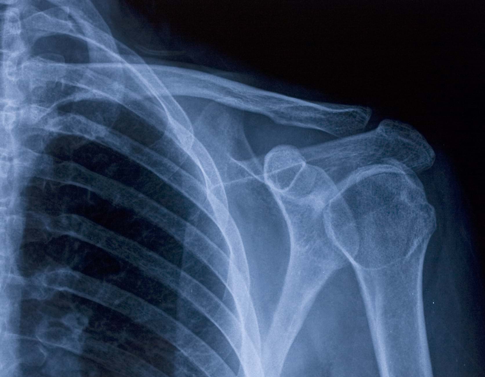 An x-ray of a shoulder