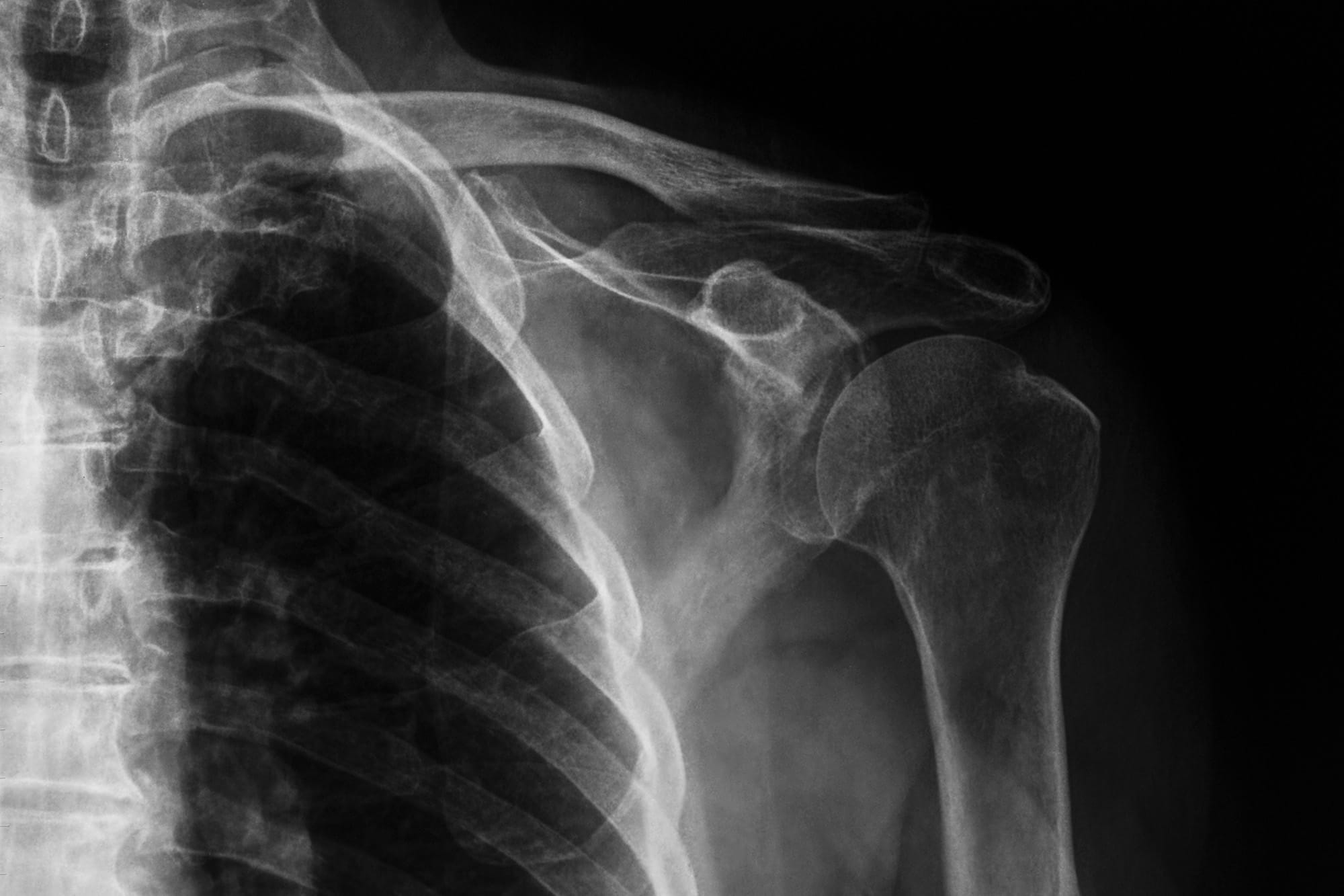 An x-ray of a shoulder