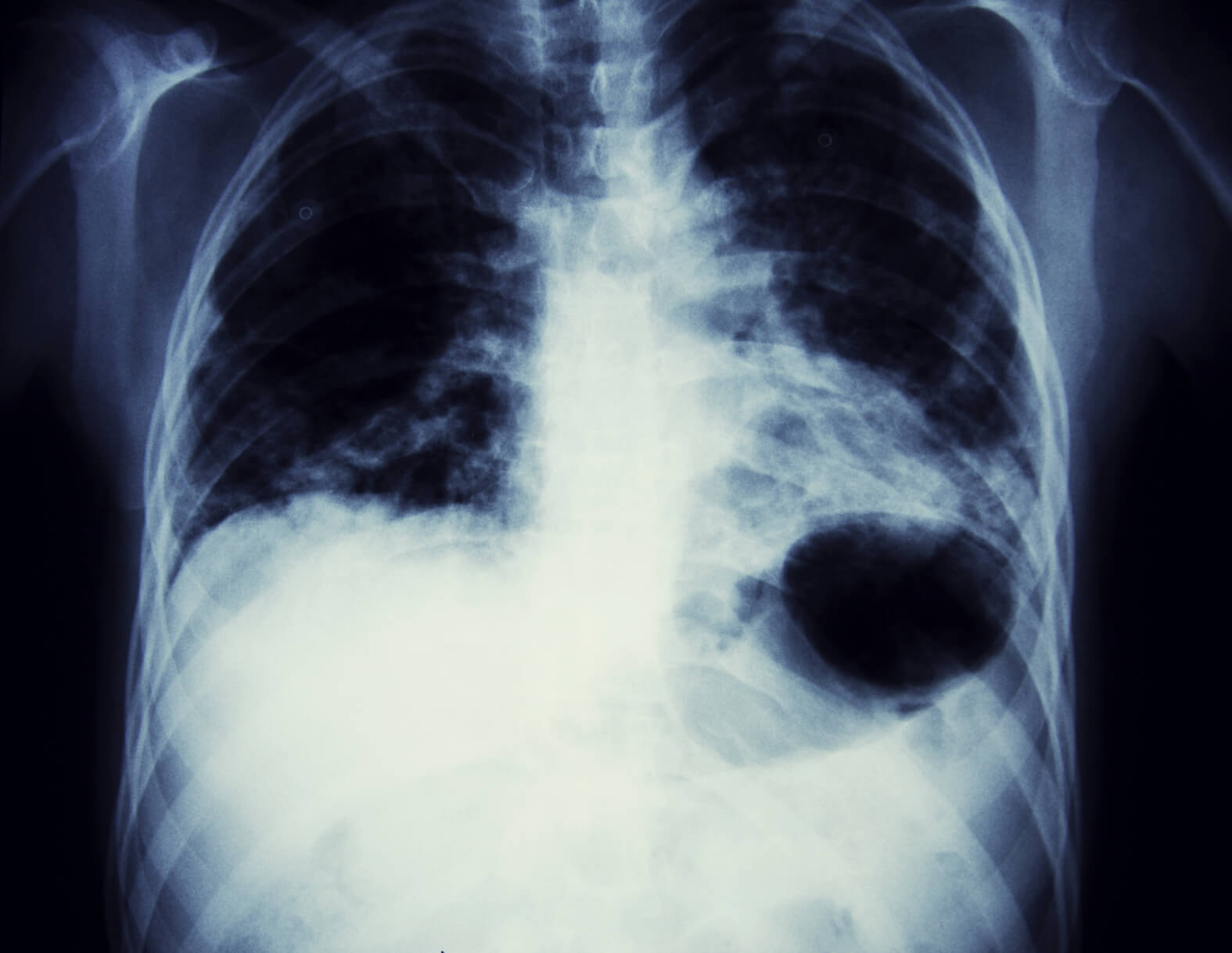 X-ray of lungs