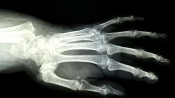 Claiming compensation for undiagnosed fractures