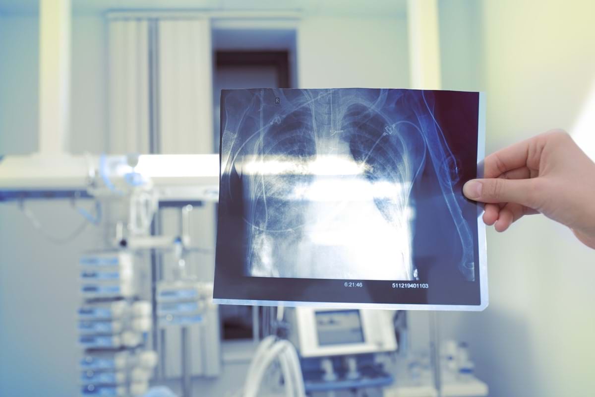 man looking at lungs x-ray
