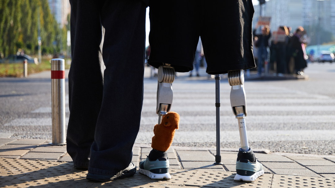 Bilateral Above-Knee Amputations: Recovery, Rehabilitation and Long-Term Support