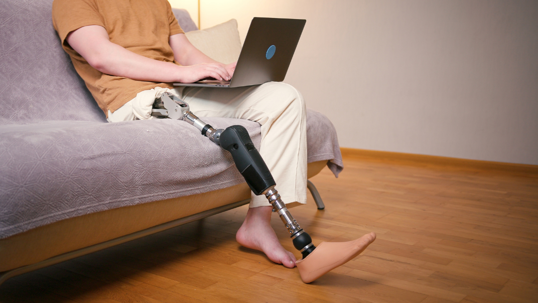 Above-the-Knee Leg Amputation: Recovery, Rehabilitation and Long-Term Support