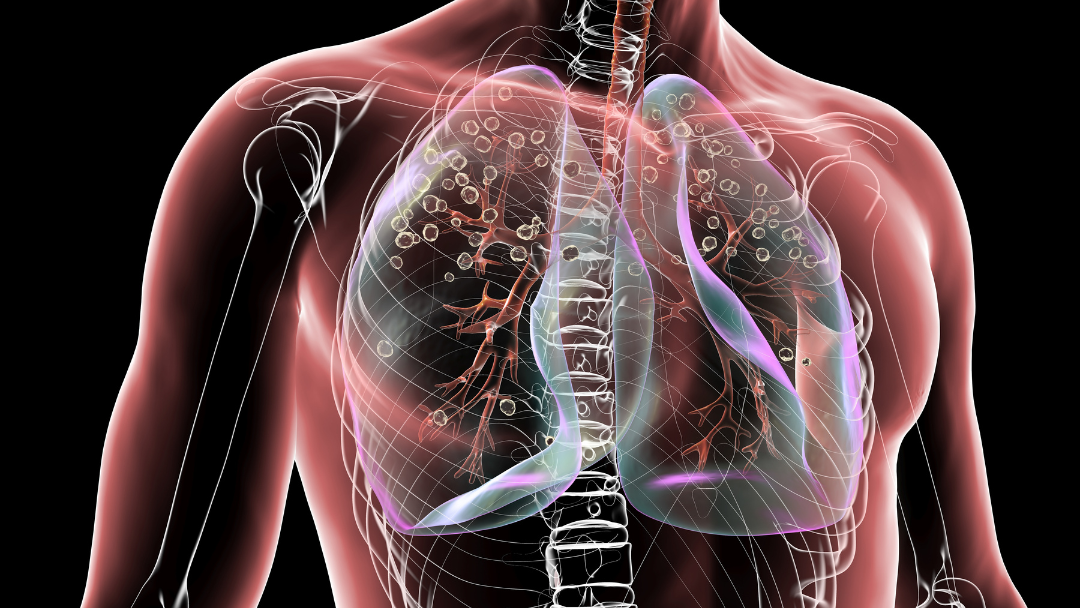 Types of Silicosis